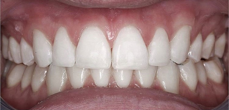 After Dental treatment - Restored with composite